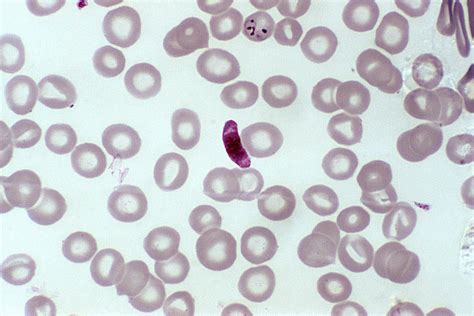  Plasmodium! Den mikroskopiska parasiten som gör dig febrig och trött 